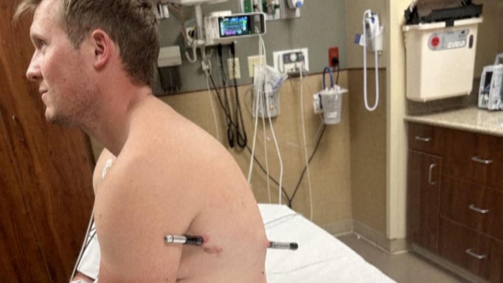 Hiker travels 10 miles with hiking pole injury in Montana